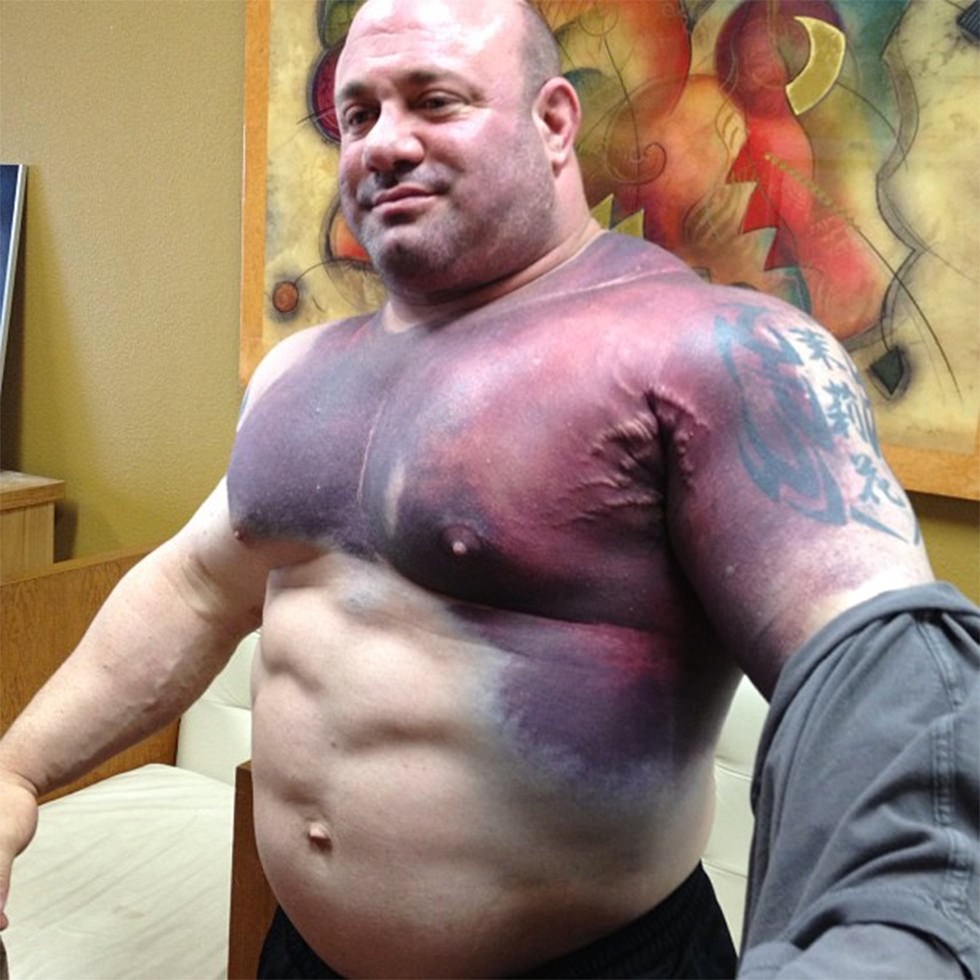 synthol side effects